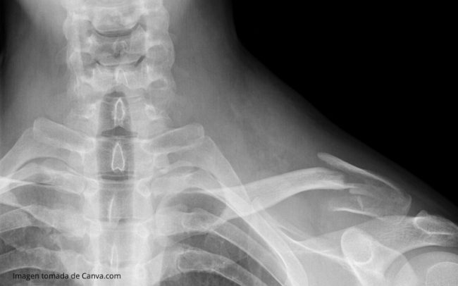 Fracturas Vertebrales en Medellin